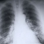 Stepped-Up Screening Would Uncover More Lung Cancers - WebMD